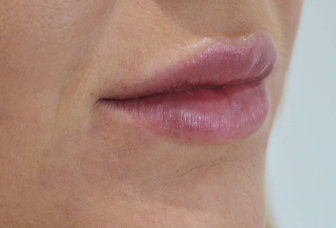 victoria-hearn-lips-after