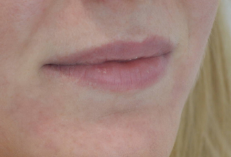 victoria-hearn-lips-before