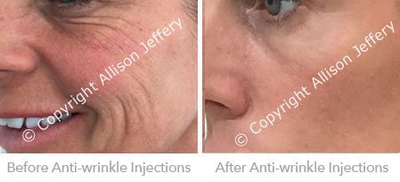 Botox - Before & After