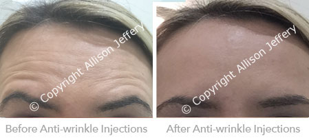Botox Before & After
