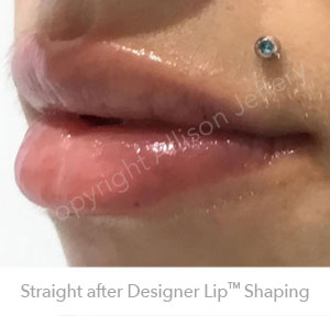 Result 4 after Designer Lip Shaping by Allison Jeffery, Brighton