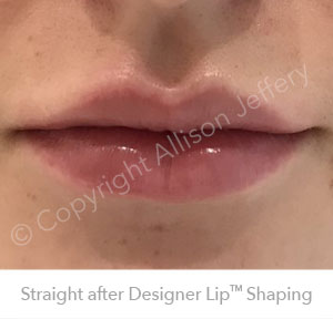 Result 3 after Designer Lip Shaping by Allison Jeffery, Brighton