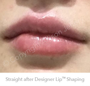 Result 2 after Designer Lip Shaping by Allison Jeffery, Brighton