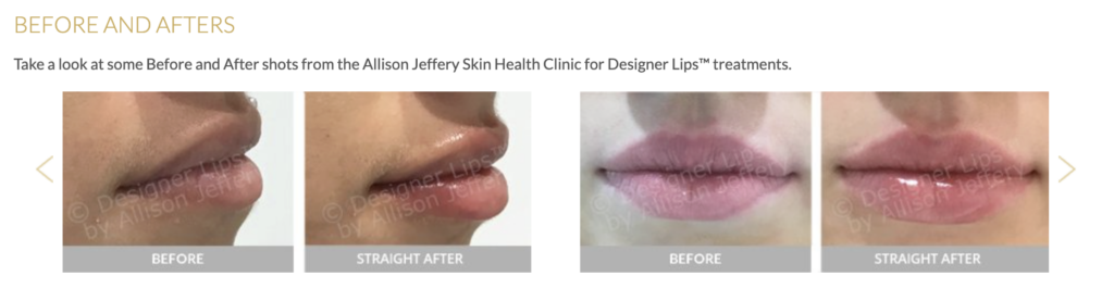 Before & after shots Allison Jeffery Designer Lip Treatments